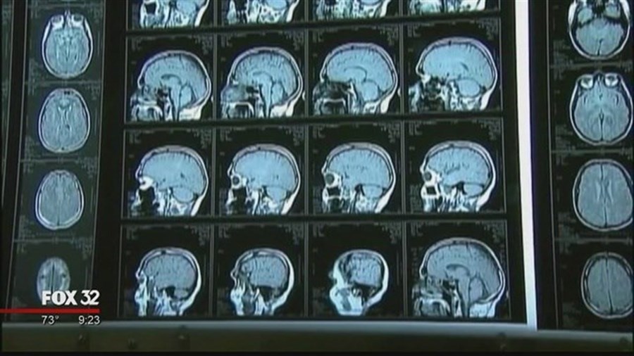 Duerson brain tissue analyzed: Suicide linked to brain disease